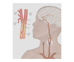Carotid Artery Disease Treatment in Lithonia | free-classifieds-usa.com - 2