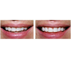 Teeth Straightening in Nokomis, FL: We Make Smiles | free-classifieds-usa.com - 3