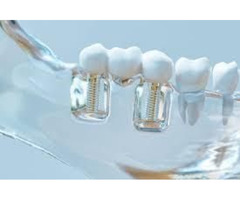 5 Factors to Consider when Choosing a Dental Implants Dentist. | free-classifieds-usa.com - 1