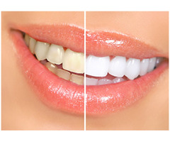 Tooth Colored Fillings in Nokomis | We Make Smiles | free-classifieds-usa.com - 2