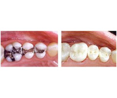 Tooth Colored Fillings in Nokomis | We Make Smiles | free-classifieds-usa.com - 4