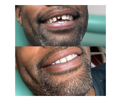 Precision Dental NYC offers a 20% discount on dental implant procedures. | free-classifieds-usa.com - 4
