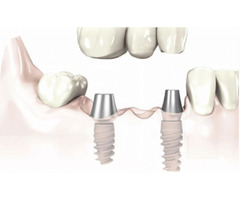Yardley Dental Implants | free-classifieds-usa.com - 1