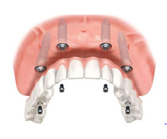 Yardley Dental Implants | free-classifieds-usa.com - 2
