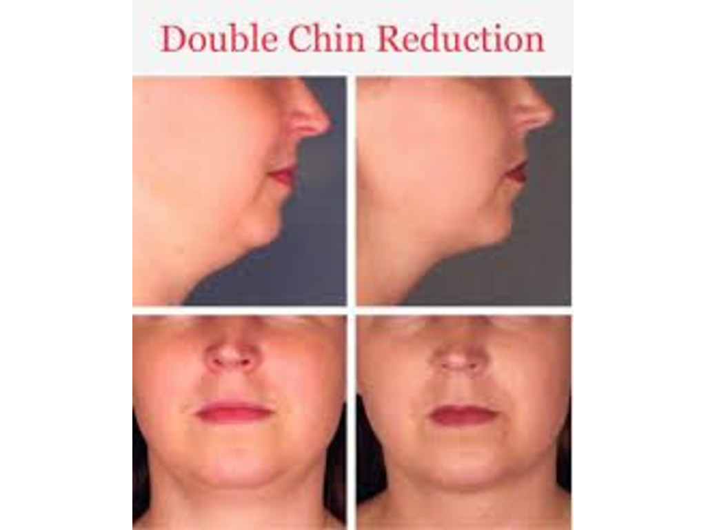 Double Chin Reduction in New York