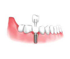 Insurance Coverage for Dental Implants: What You Should Know. | free-classifieds-usa.com - 1