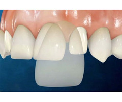 Best Veneer Treatment in Kendall FL - Miami Dental Group | free-classifieds-usa.com - 2