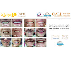 Dental Bridges service in Naples, FL from Dr. Daniyar - Shine Smile | free-classifieds-usa.com - 1