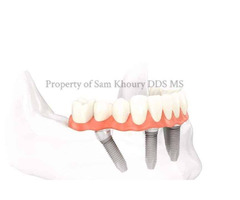 Dental Implants in Wilmington DE | free-classifieds-usa.com - 1