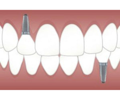 Dental Implants in Houston, TX | free-classifieds-usa.com - 1