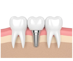Dental implants in O'Fallon | free-classifieds-usa.com - 1