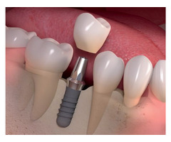 Best Dental Implants in Boynton Beach Florida | free-classifieds-usa.com - 1