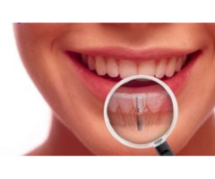 Best Dental Implants in Boynton Beach Florida | free-classifieds-usa.com - 2