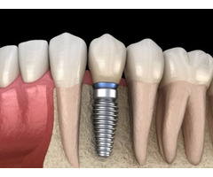 Dental Implants in Greenville, SC | free-classifieds-usa.com - 1