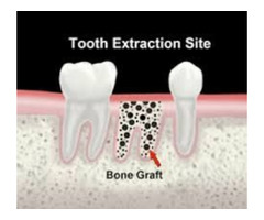 Teeth Extractions | free-classifieds-usa.com - 1