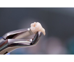 Tooth Extraction in O'Fallon, MO | free-classifieds-usa.com - 1