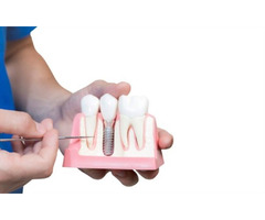 Dental Implants in O'Fallon | free-classifieds-usa.com - 1
