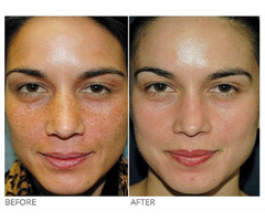 Are You Looking For Vi Peel Treatment in NYC? | free-classifieds-usa.com - 2