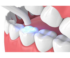 Cavity Fillings in Albion NY - Albion Family Dental | free-classifieds-usa.com - 3