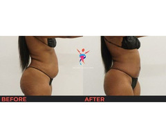 Premier Liposuction in Las Vegas, NV | free-classifieds-usa.com - 3