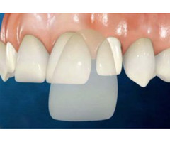 Dental Veneers in Homestead FL - Smile Plus Homestead | free-classifieds-usa.com - 2