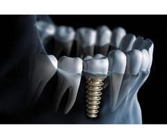 Dental Implant in Rochester, NY - Dental Implants & Periodontal Health | free-classifieds-usa.com - 3