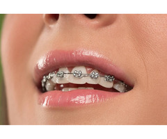 Straighten Your Teeth Discreetly with Clear Braces - Top-Rated Dental Clinic | free-classifieds-usa.com - 1