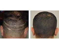 Best Hairline Restoration Las Vegas, NV | free-classifieds-usa.com - 1