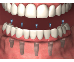 Dental Implants, Same Day Smiles of Coral Springs | free-classifieds-usa.com - 1