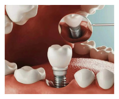 Transform Your Confidence: Best Dental Implants Near Orefield | free-classifieds-usa.com - 1