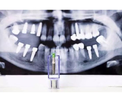 Regain Your Smile's Strength with All-on-4 Dental Implants in Ventura, CA | free-classifieds-usa.com - 1