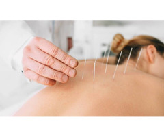 Best Cupping Therapy Clinic in Burlingame | free-classifieds-usa.com - 1
