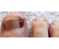 Ingrown toenail treatment in Florida | free-classifieds-usa.com - 1