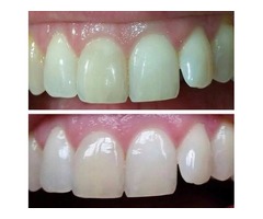 Tooth Whitening Toothpaste | free-classifieds-usa.com - 1