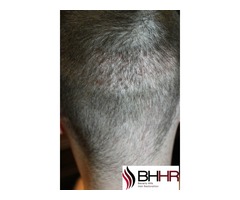 Hair Restoration at Beverly Hills, California | free-classifieds-usa.com - 2