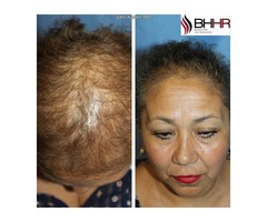 Hair Restoration at Beverly Hills, California | free-classifieds-usa.com - 3