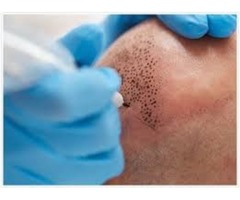 Eyebrow and scalp micropigmentation 3D At Beverly Hills | free-classifieds-usa.com - 2