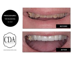 Teeth Cleaning or Teeth Whitening Dentistry in Houston TX | free-classifieds-usa.com - 1