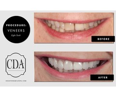 Teeth Cleaning or Teeth Whitening Dentistry in Houston TX | free-classifieds-usa.com - 2